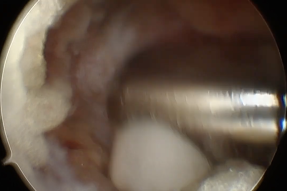 Technique permettant de réaliser la chirurgie de 'hernie discale avec un taux d'infection et de fibrose